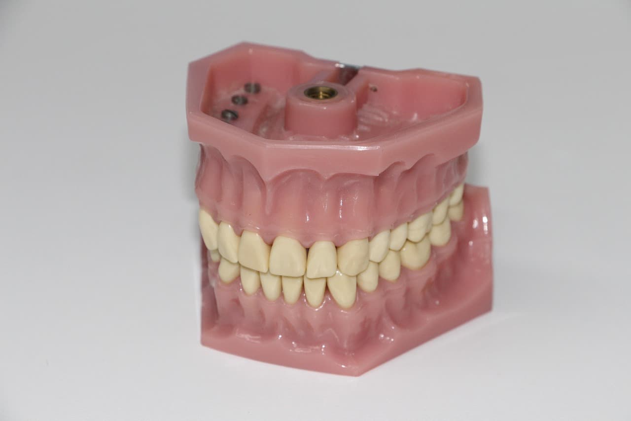 A model of a denture held in place by dental implants